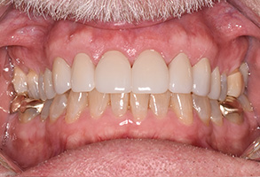 North Texas Dental Care | Sports Mouthguards, E4D and Dental Lab