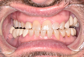 North Texas Dental Care | CEREC  , Emergency Treatment and Sports Mouthguards