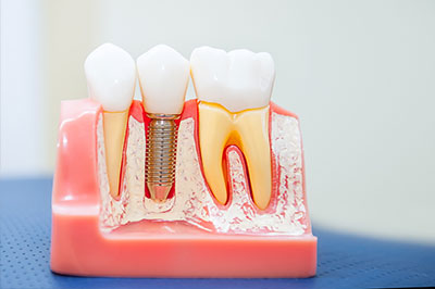 North Texas Dental Care | Dental Fillings, Teeth Whitening and E4D