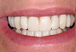 North Texas Dental Care | All-on-6 reg , Teeth Whitening and Snoring Appliances