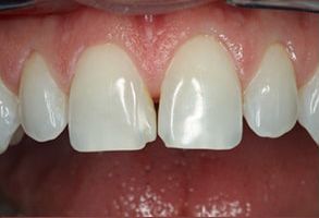 North Texas Dental Care | Teeth Whitening, Same-Day Repairs and All-on-6 reg 